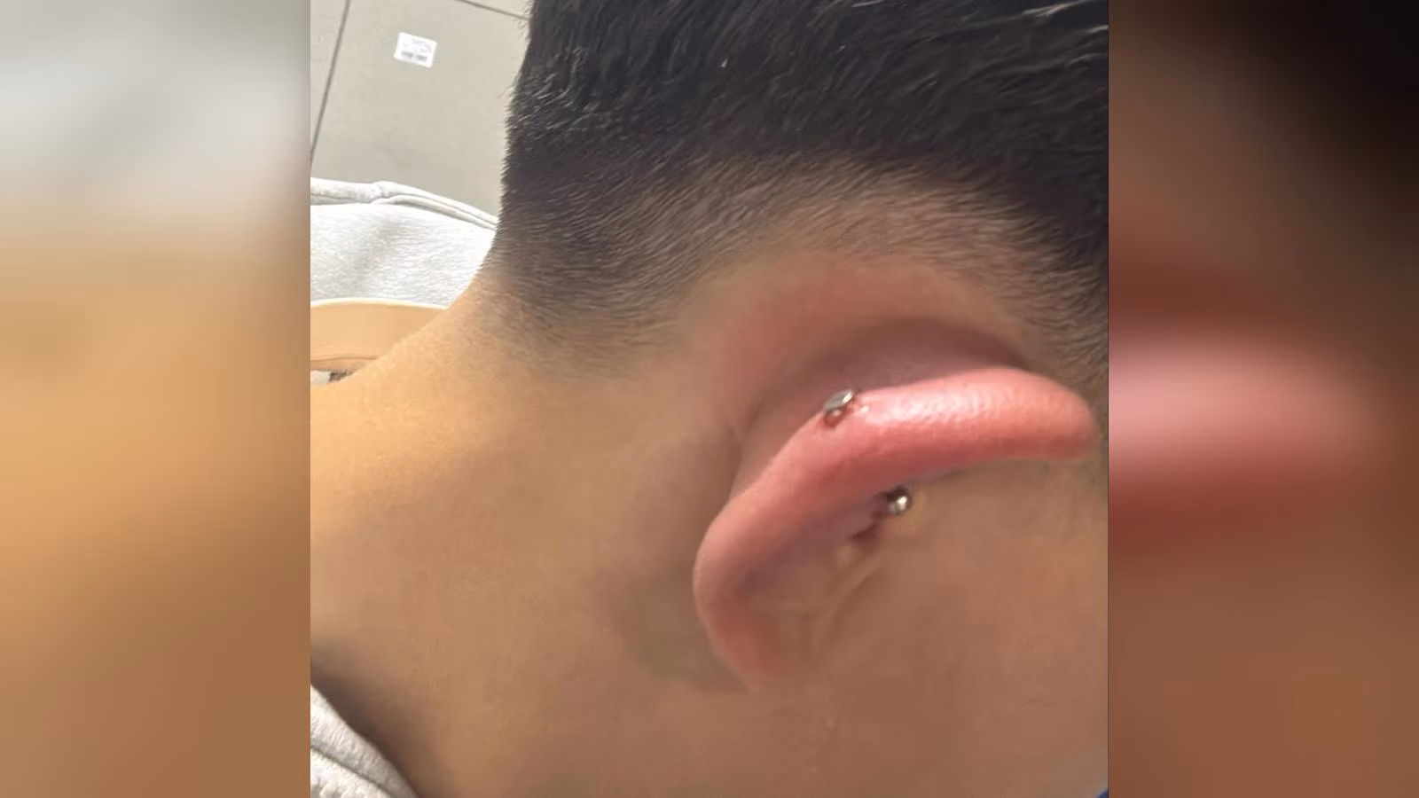 Kısa saçlı bir kişinin kızarmış ve şişmiş kulağı; kulak kıkırdağına takılı iki metal piercing görünüyor.